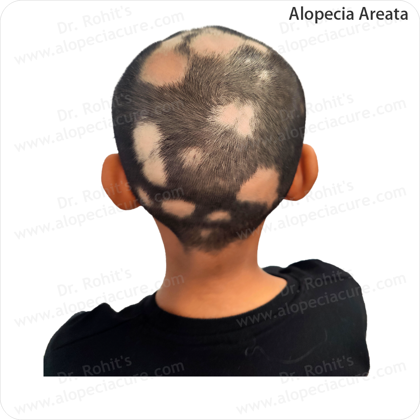 Clinical Hair Treatment