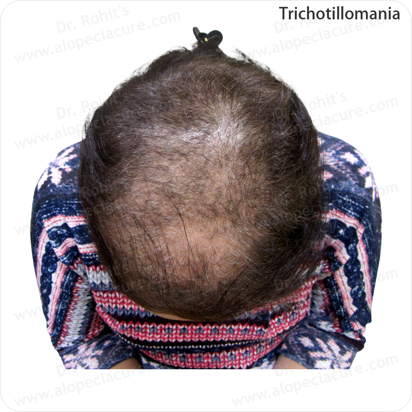 Alopecia Result