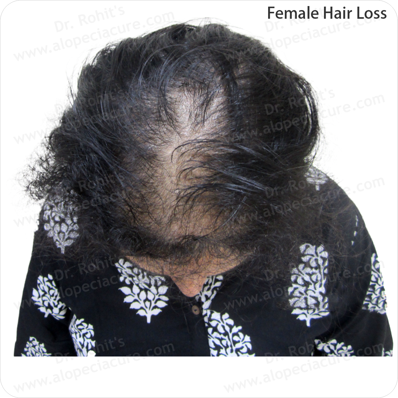 Alopecia Result