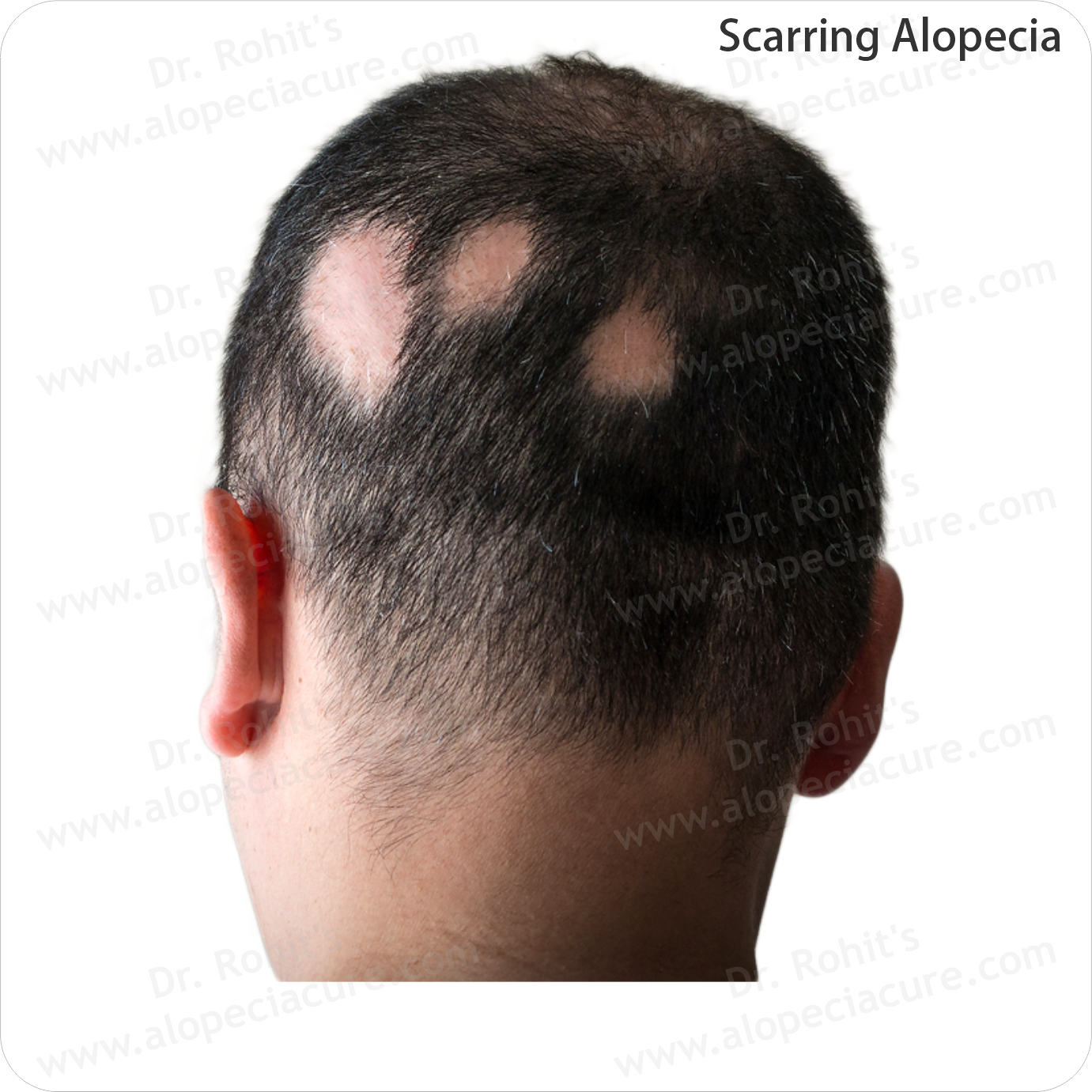 Hair Regrowth Success
