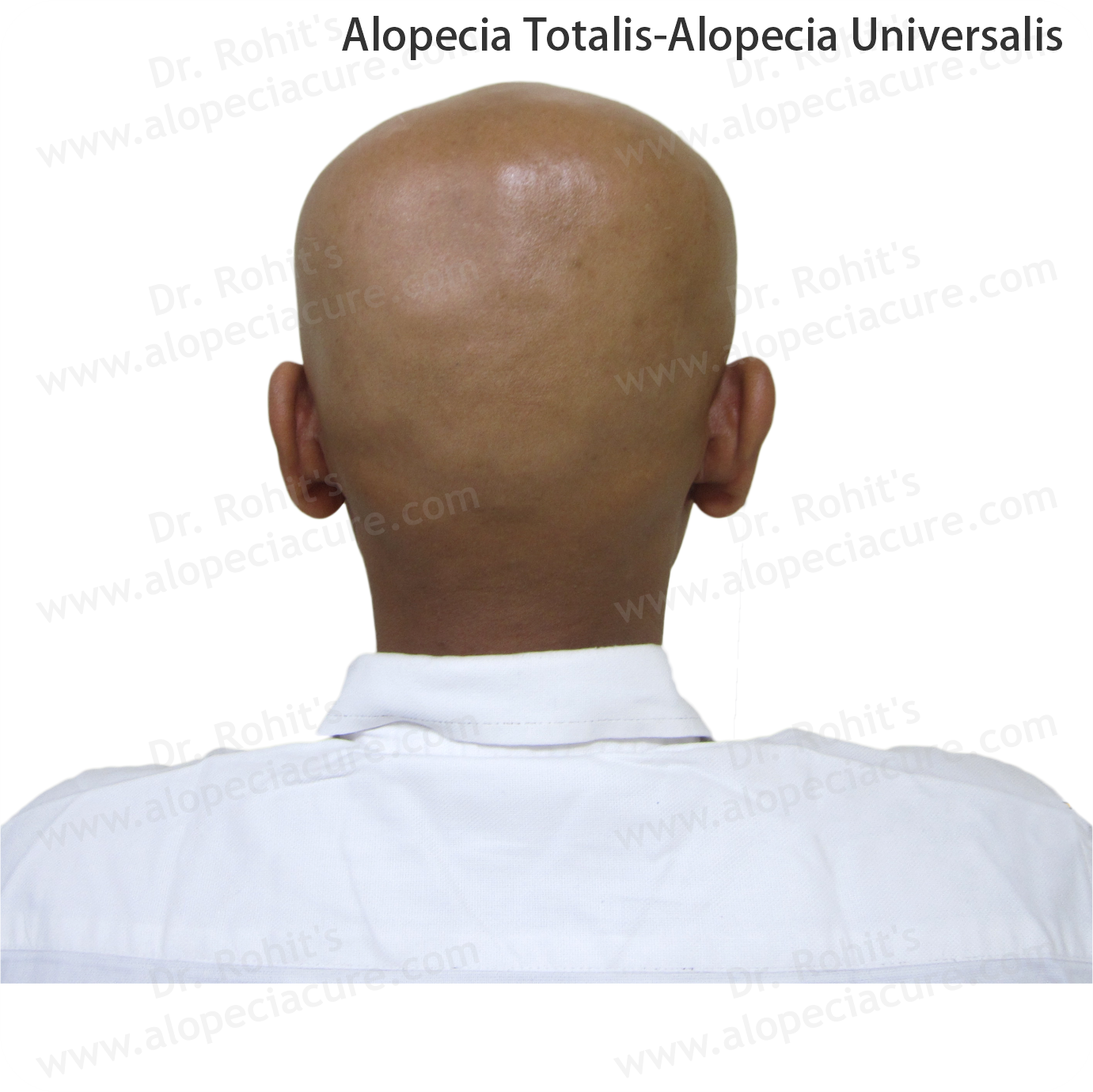 Alopecia Totalis and Universalis Treatment 1