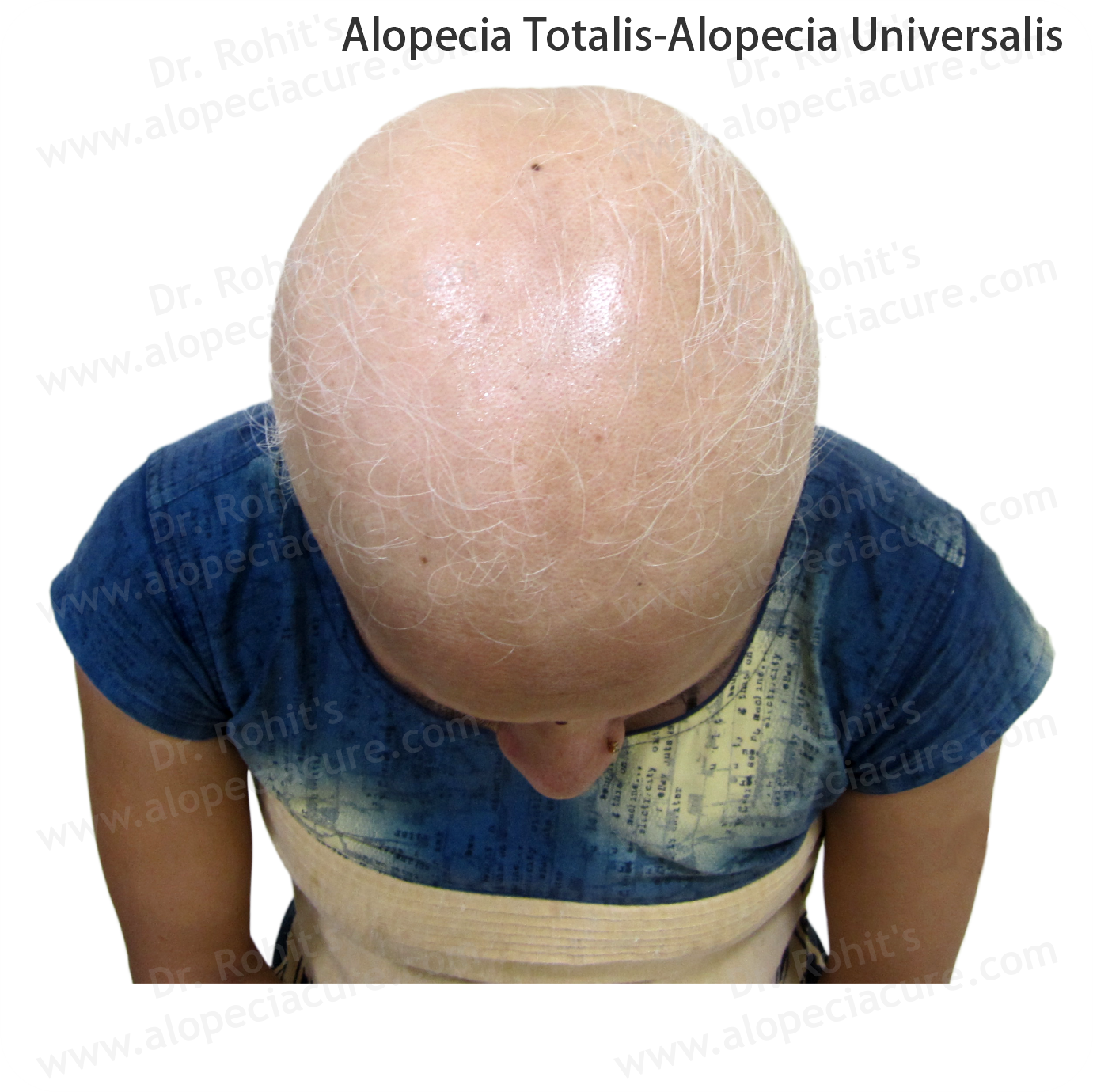 Alopecia Totalis and Universalis Treatment 2