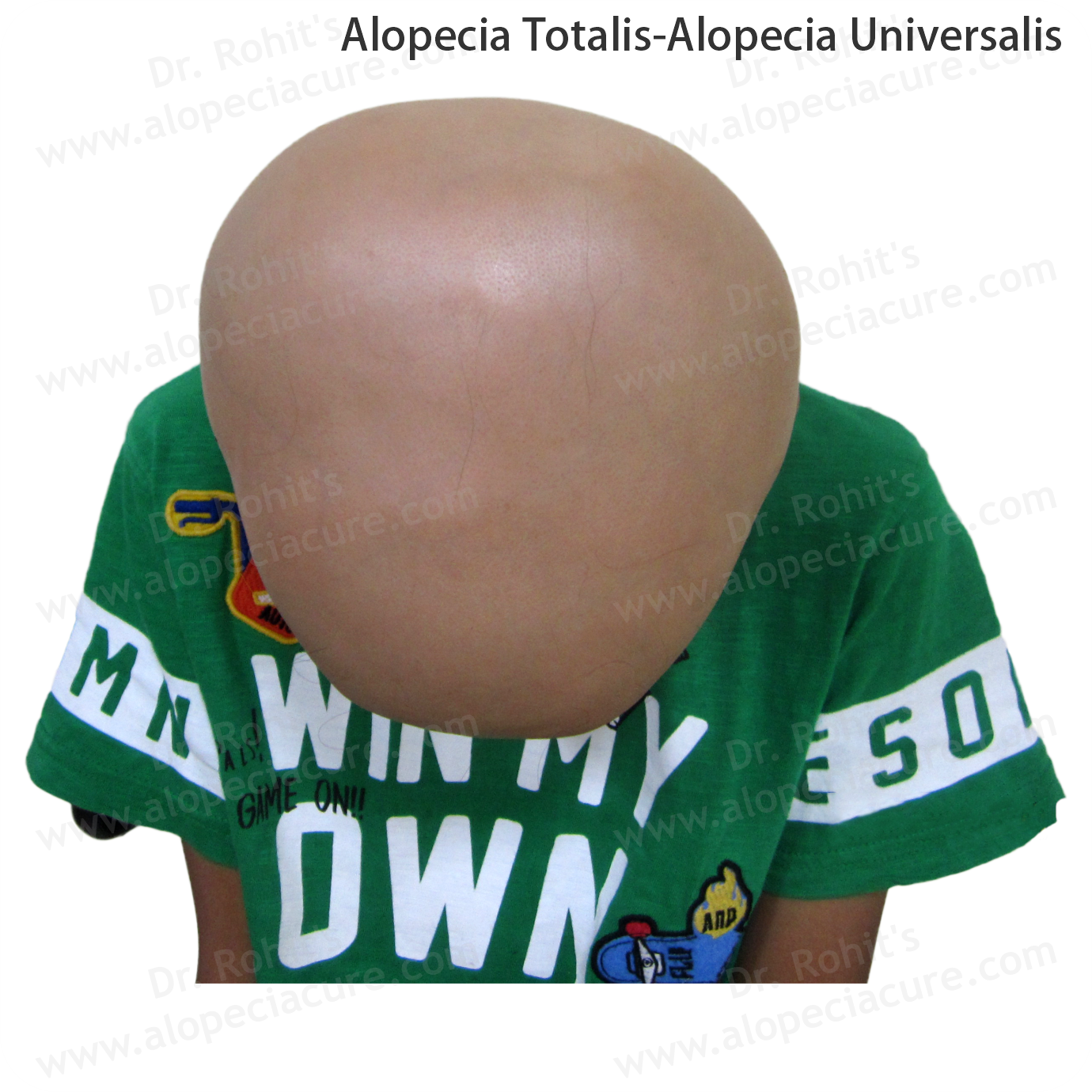 Alopecia Totalis and Universalis Treatment 3