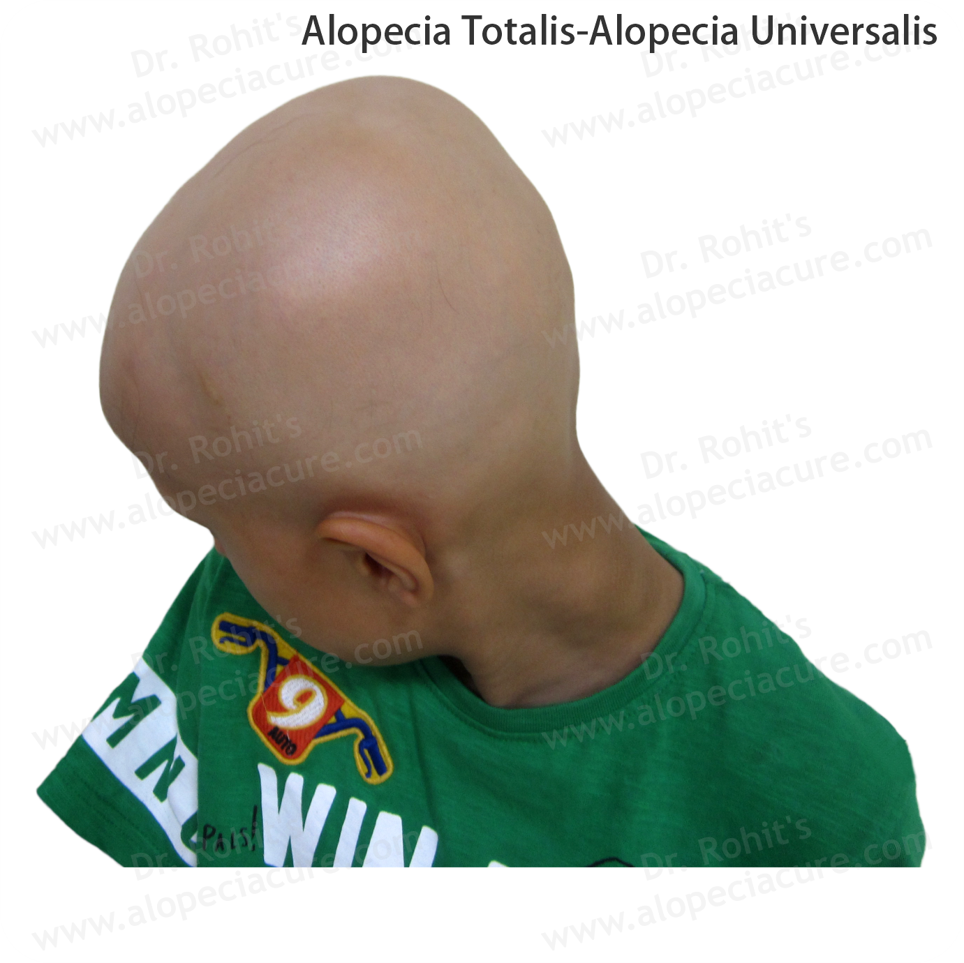 Alopecia Totalis and Universalis Treatment 4