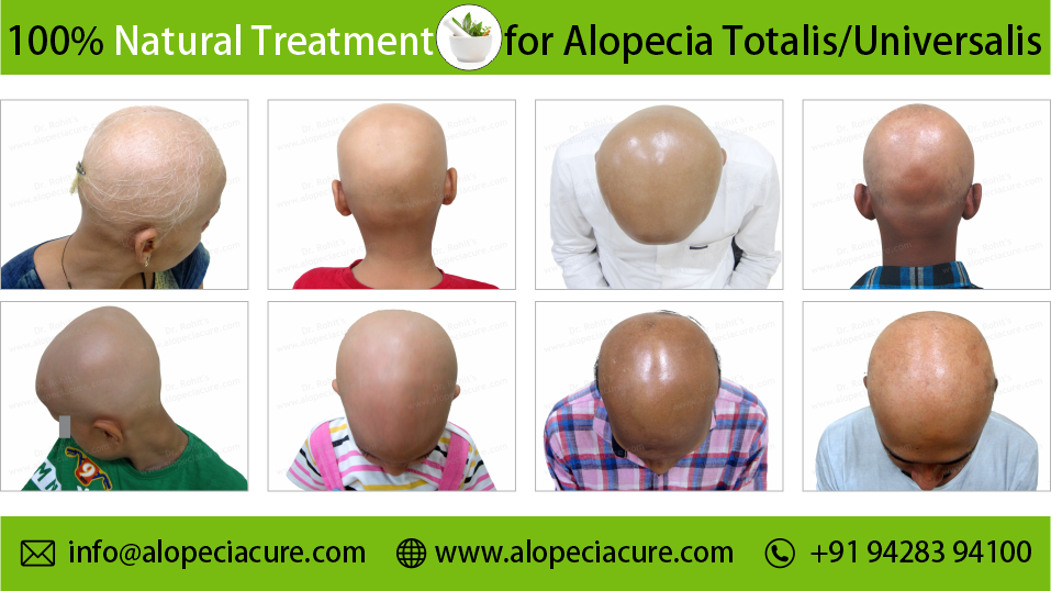 Patchy Alopecia Areata