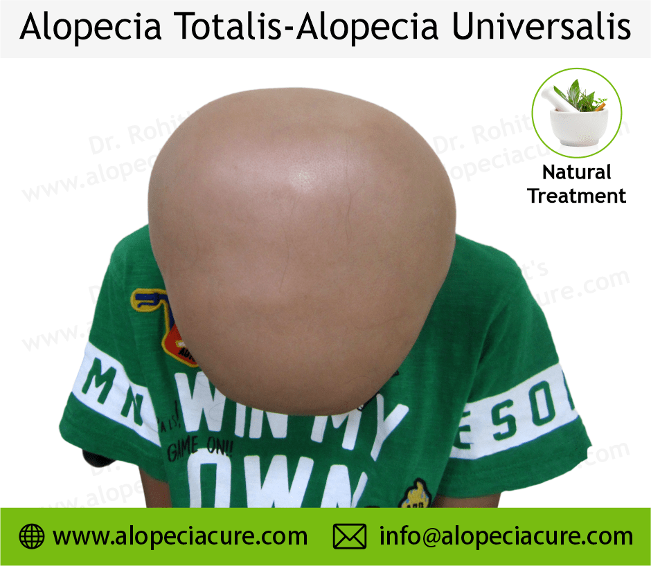 Alopecia Totalis Treatment Case 01