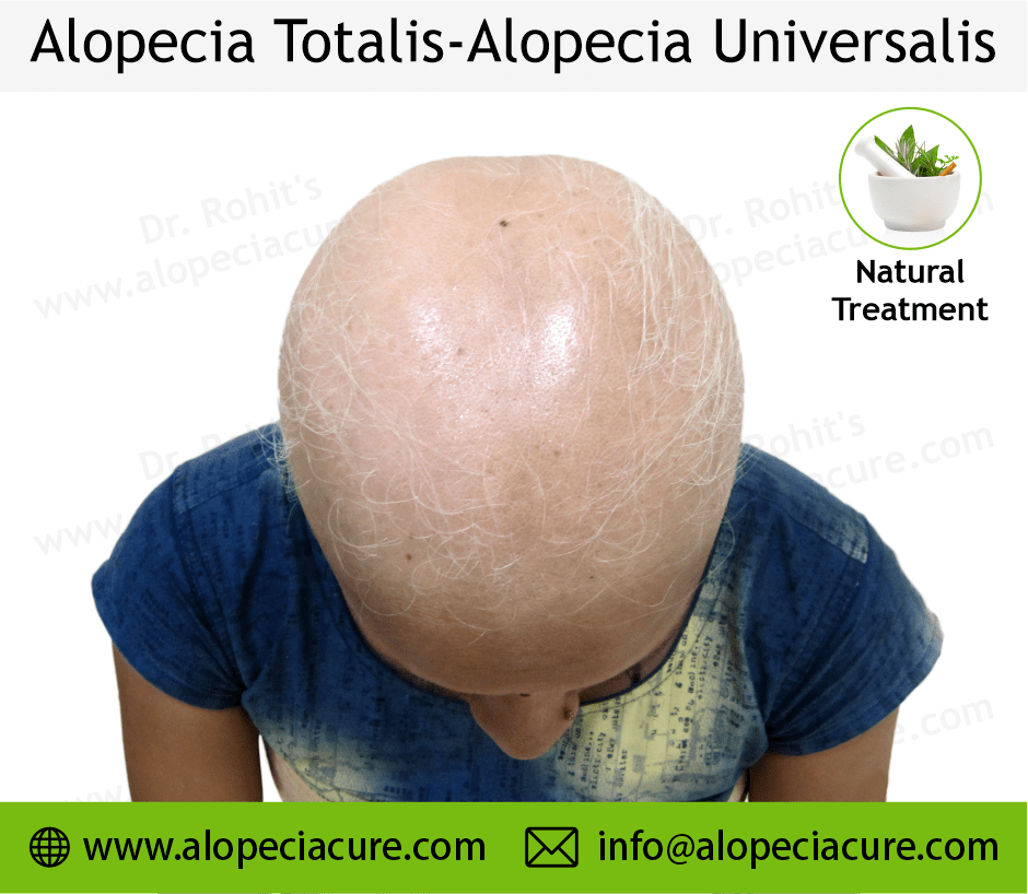 Alopecia Totalis Treatment Case 02