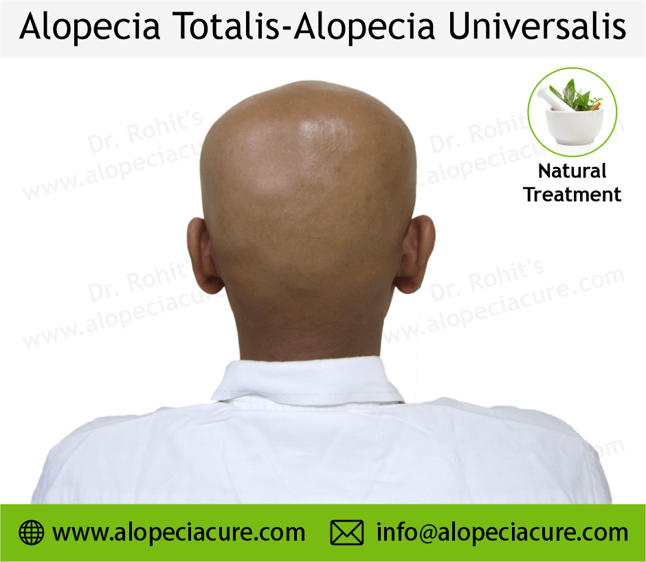 Alopecia Totalis Treatment Case 03