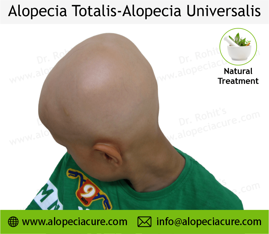 Alopecia Totalis Treatment Case 04