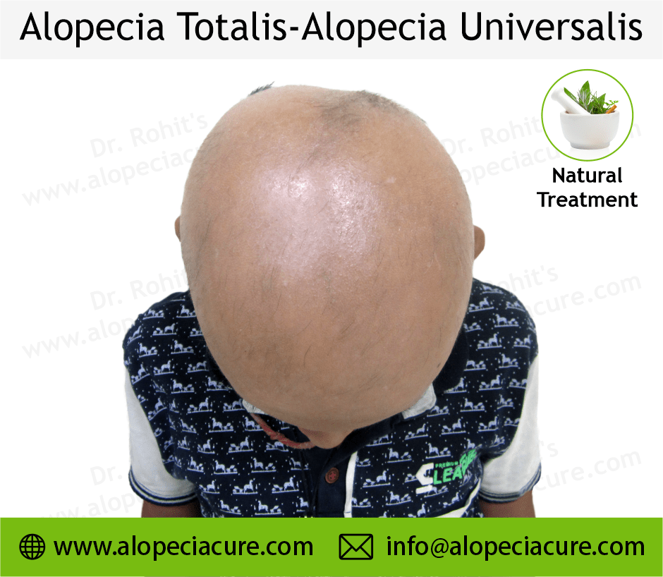 Alopecia Totalis Treatment Case 05