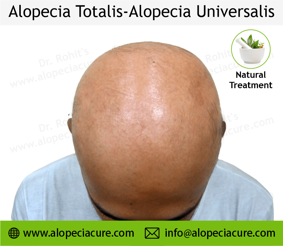 Alopecia Totalis Treatment Case 06