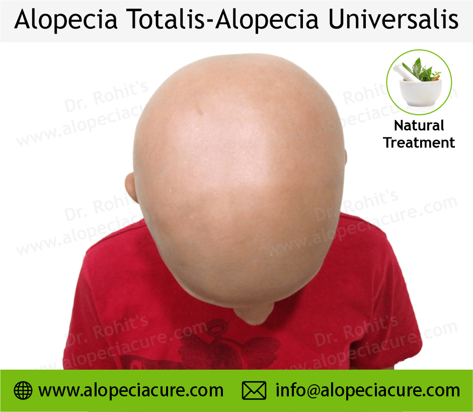 Alopecia Totalis Treatment Case 07