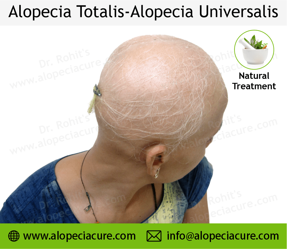 Alopecia Totalis Treatment Case 08