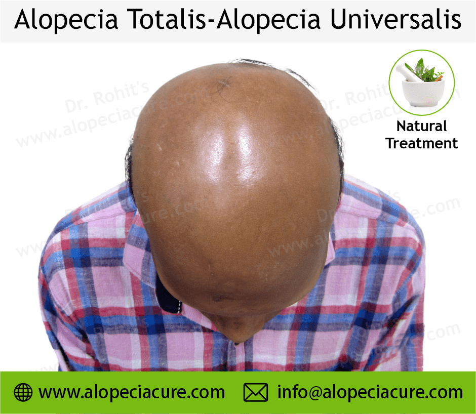 Alopecia Totalis Treatment Case 09