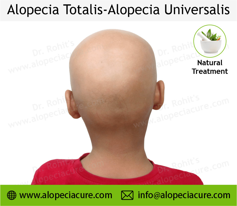 Alopecia Totalis Treatment Case 10