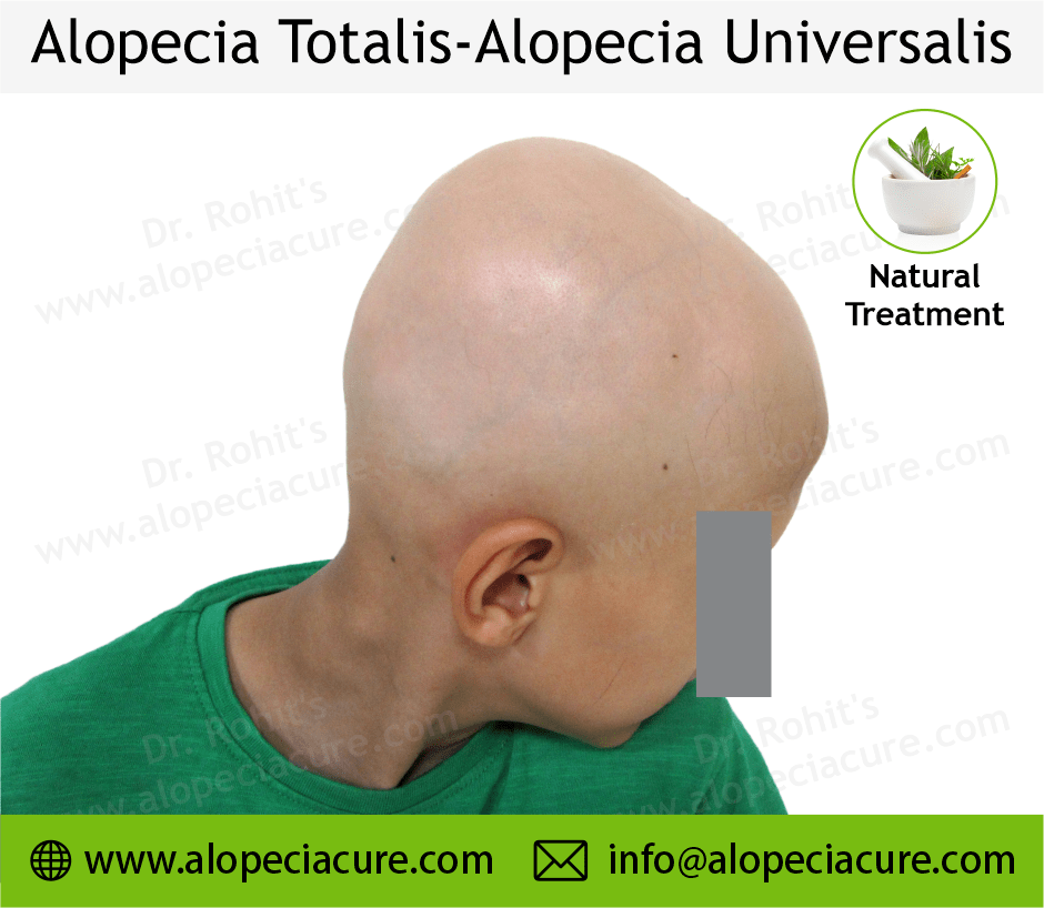 Alopecia Totalis Treatment Case 11