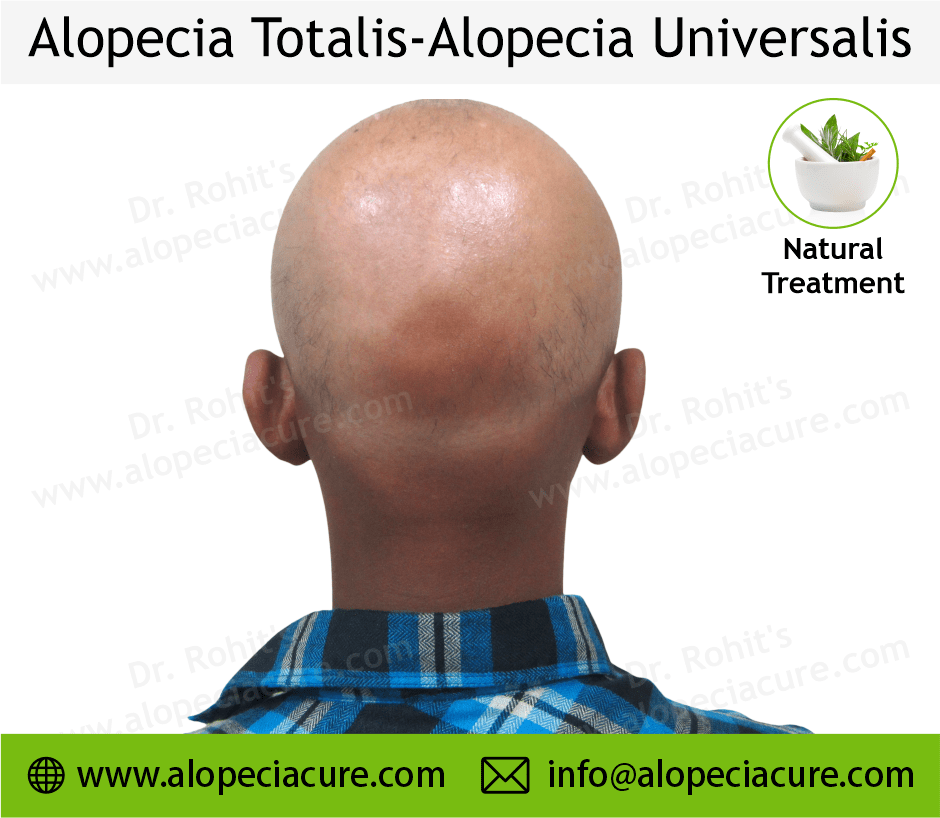 Alopecia Totalis Treatment Case 12