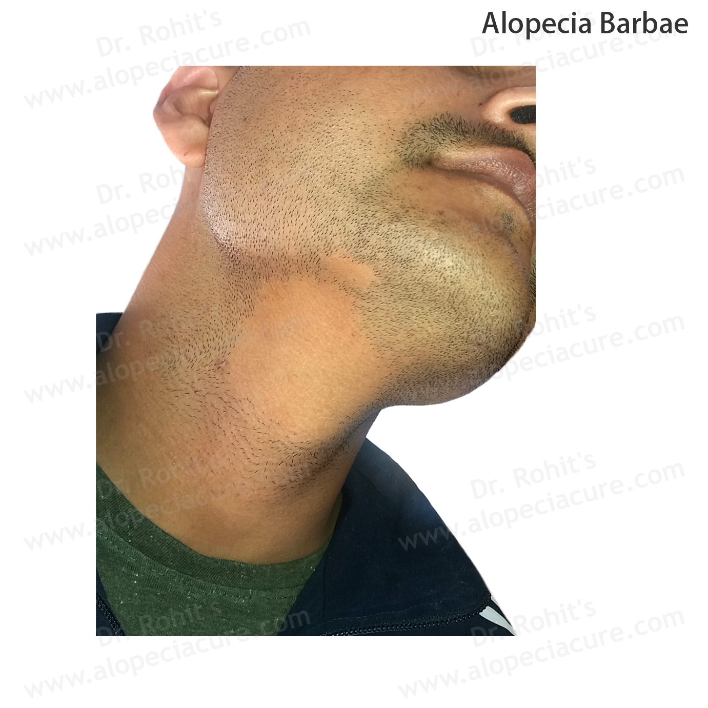 Alopecia Barbae Treatment 1