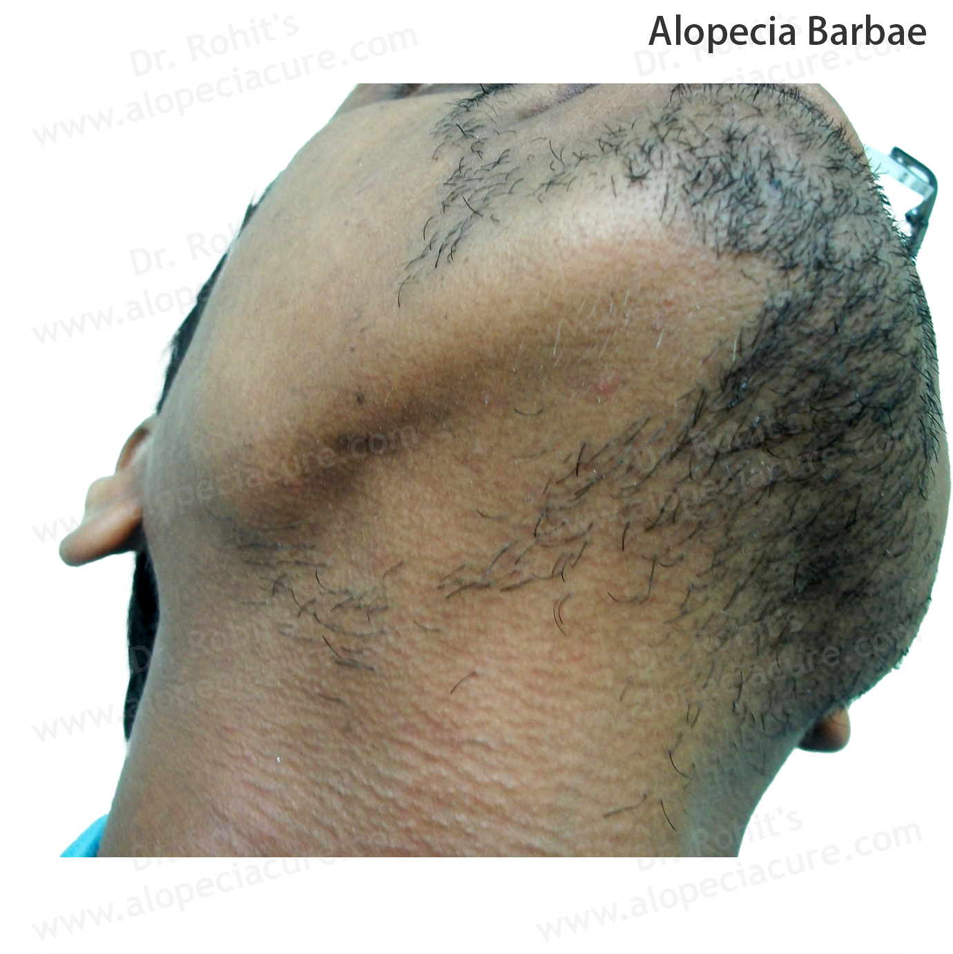 Alopecia Barbae Treatment 2