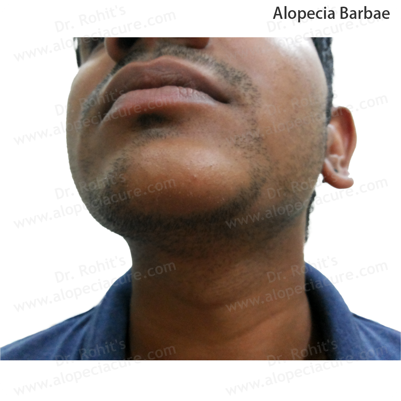Alopecia Barbae Treatment 3