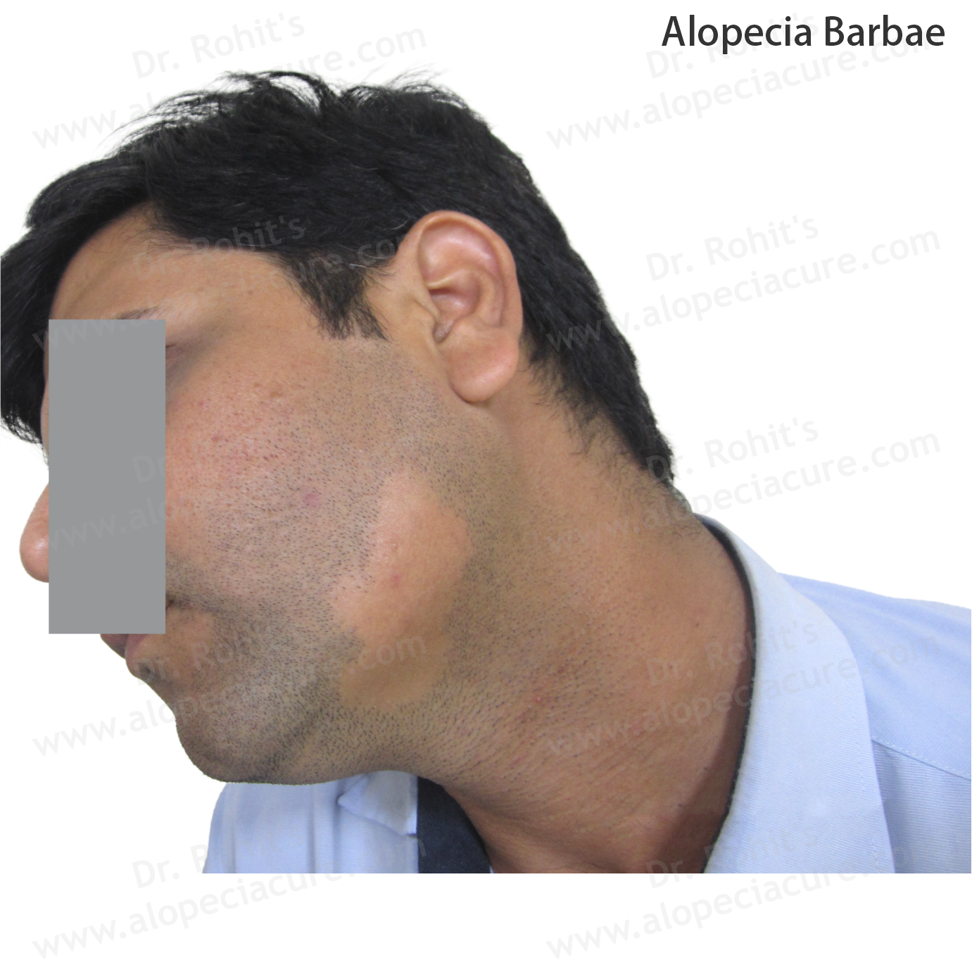 Alopecia Barbae Treatment 4