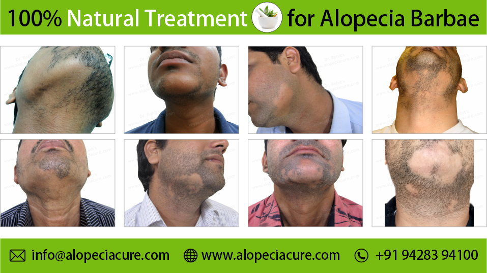 Patchy Alopecia Areata