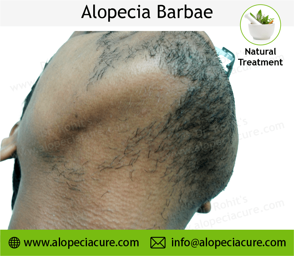 Alopecia Barbae Treatment Case 01
