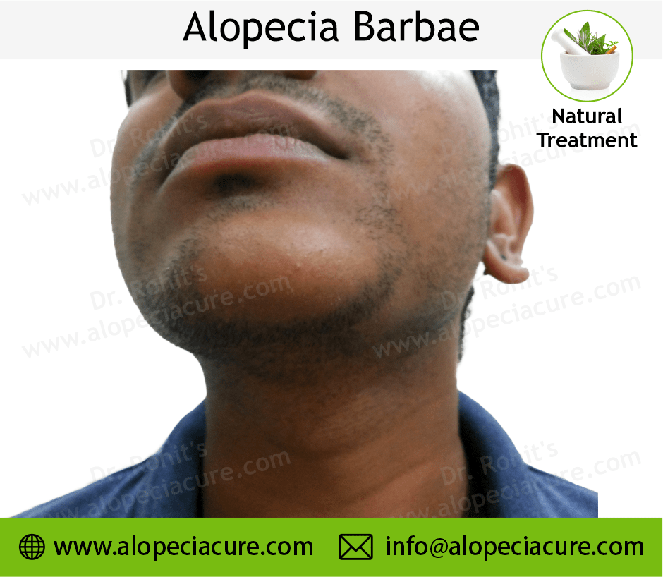 Alopecia Barbae Treatment Case 02