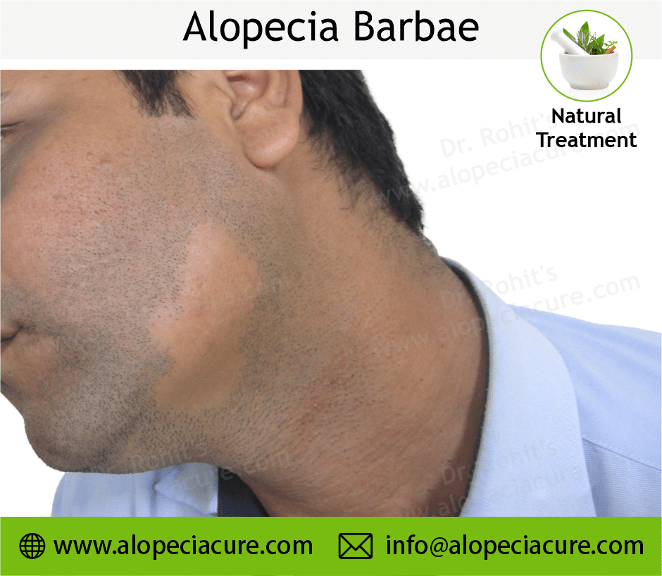 Alopecia Barbae Treatment Case 03