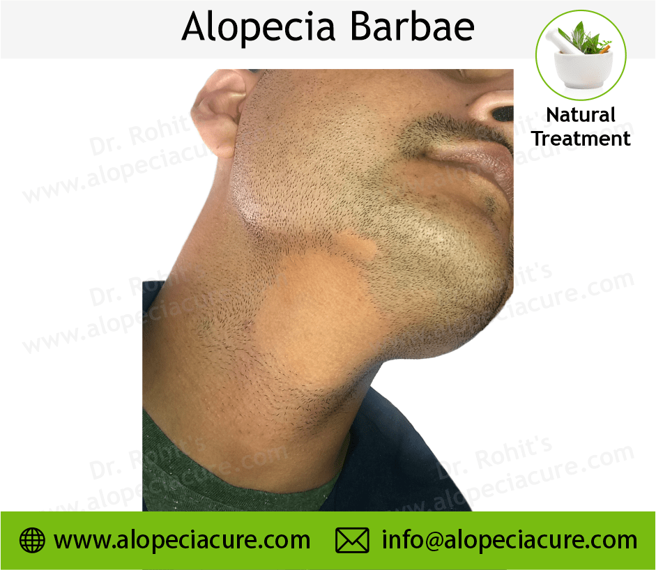 Alopecia Barbae Treatment Case 04