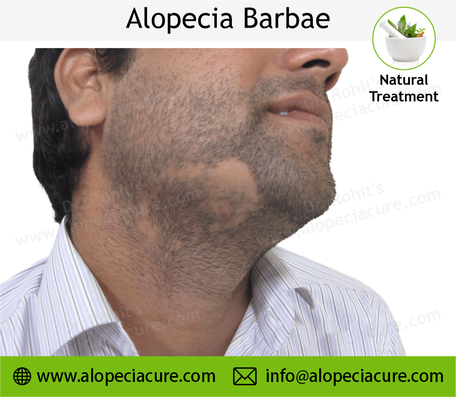 Alopecia Barbae Treatment Case 05