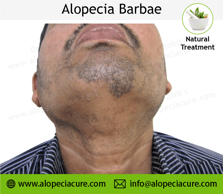 Alopecia Barbae Treatment Case 06