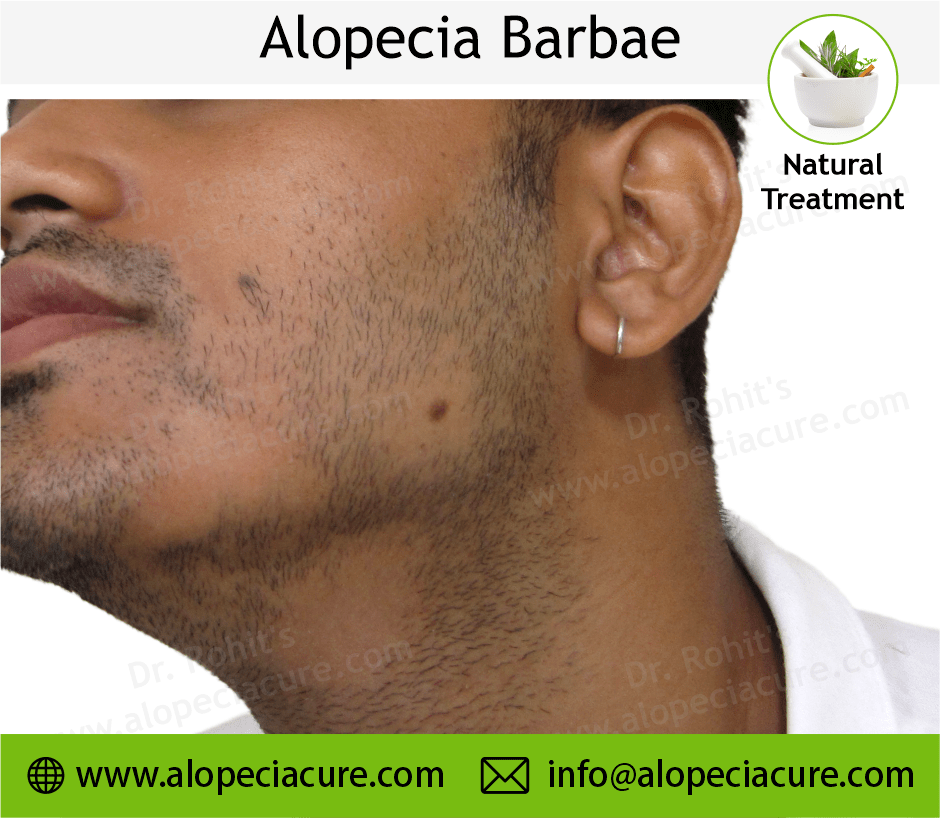 Alopecia Barbae Treatment Case 07