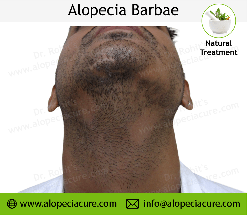 Alopecia Barbae Treatment Case 08