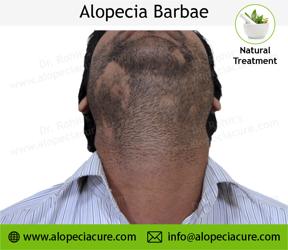 Alopecia Barbae Treatment Case 09