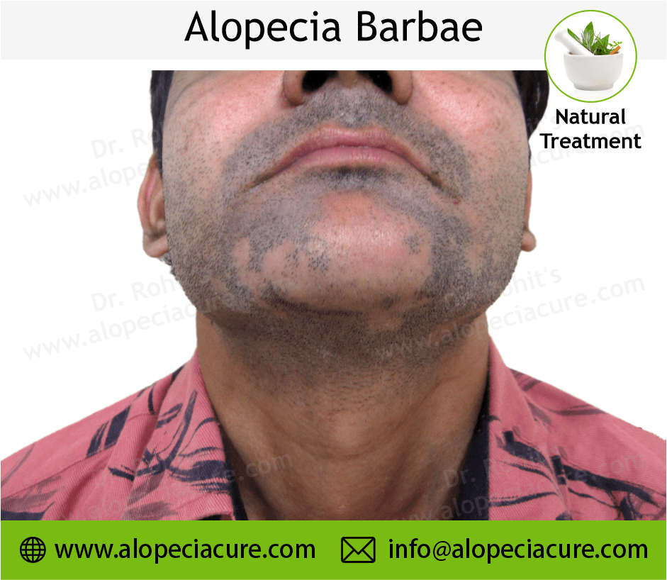 Alopecia Barbae Treatment Case 10