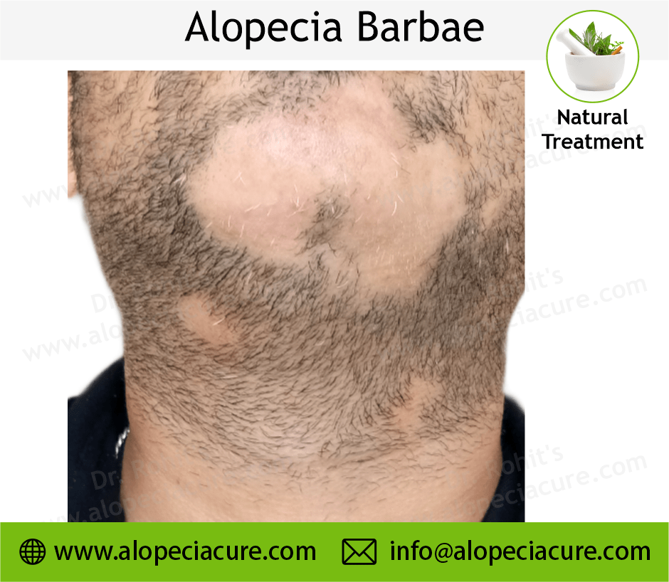 Alopecia Barbae Treatment Case 11