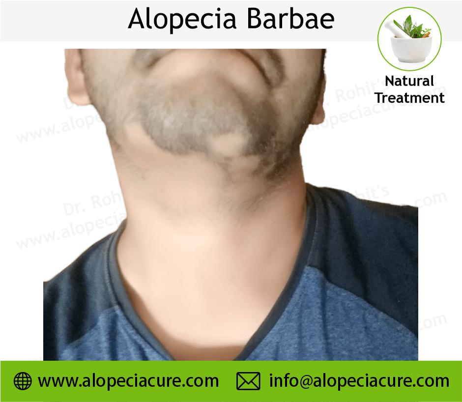 Alopecia Barbae Treatment Case 12