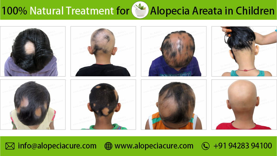 Patchy Alopecia Areata
