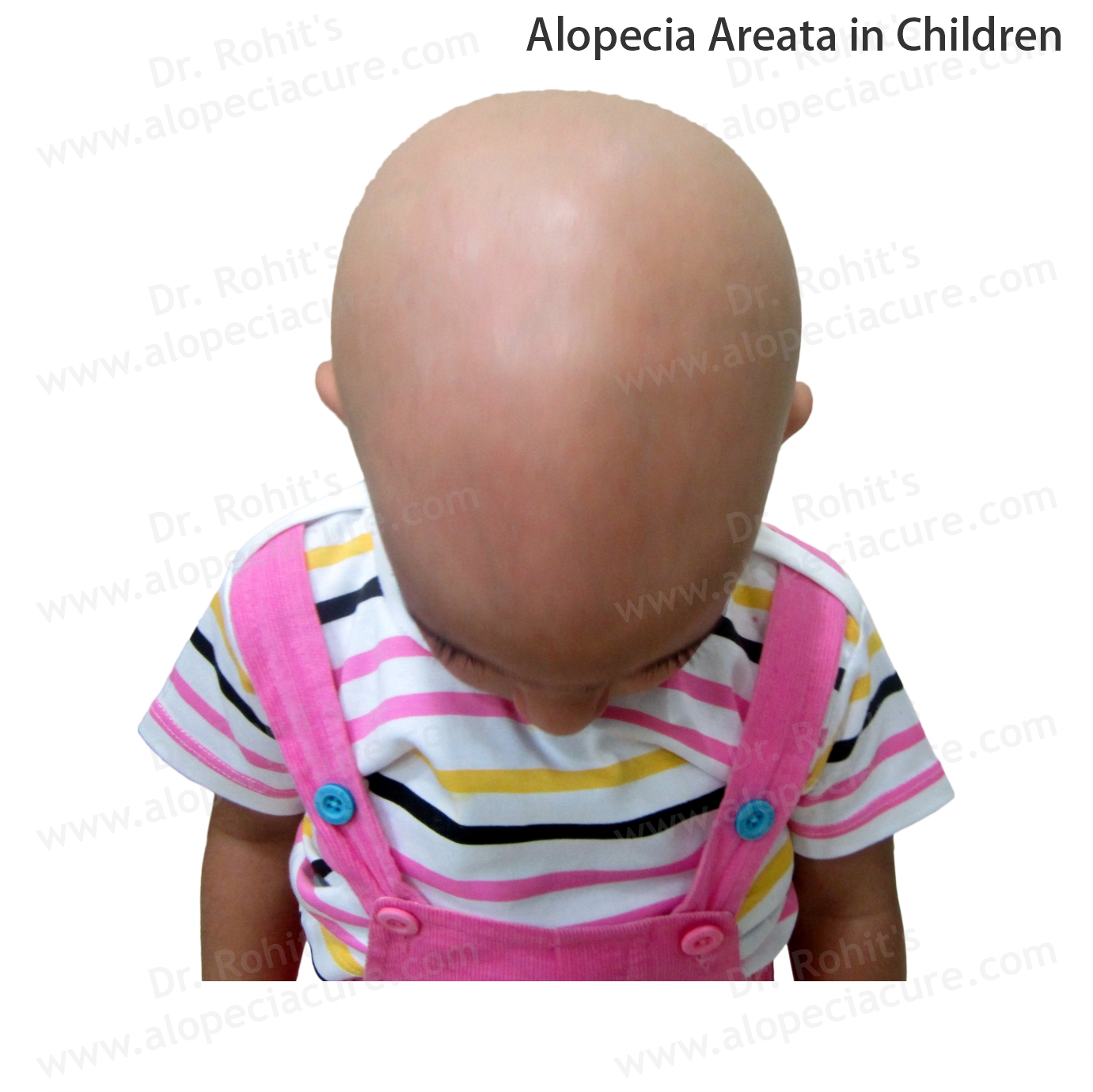 Children Alopecia Treatment 1