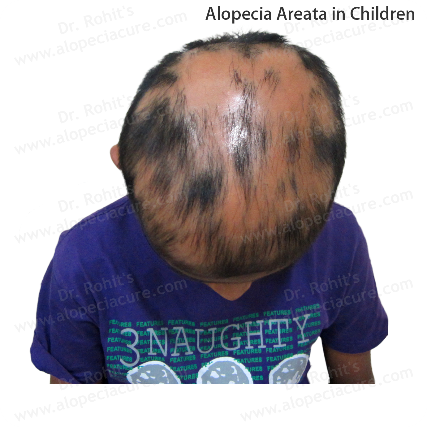 Children Alopecia Treatment 2