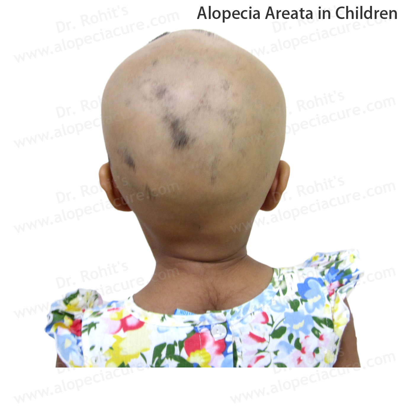 Children Alopecia Treatment 3