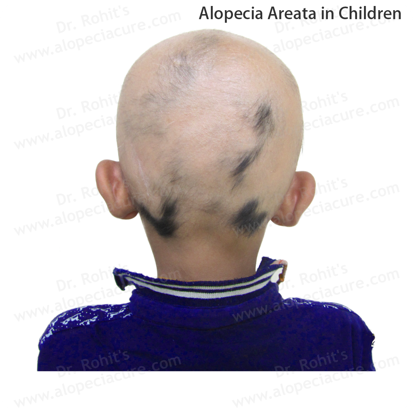 Children Alopecia Treatment 4