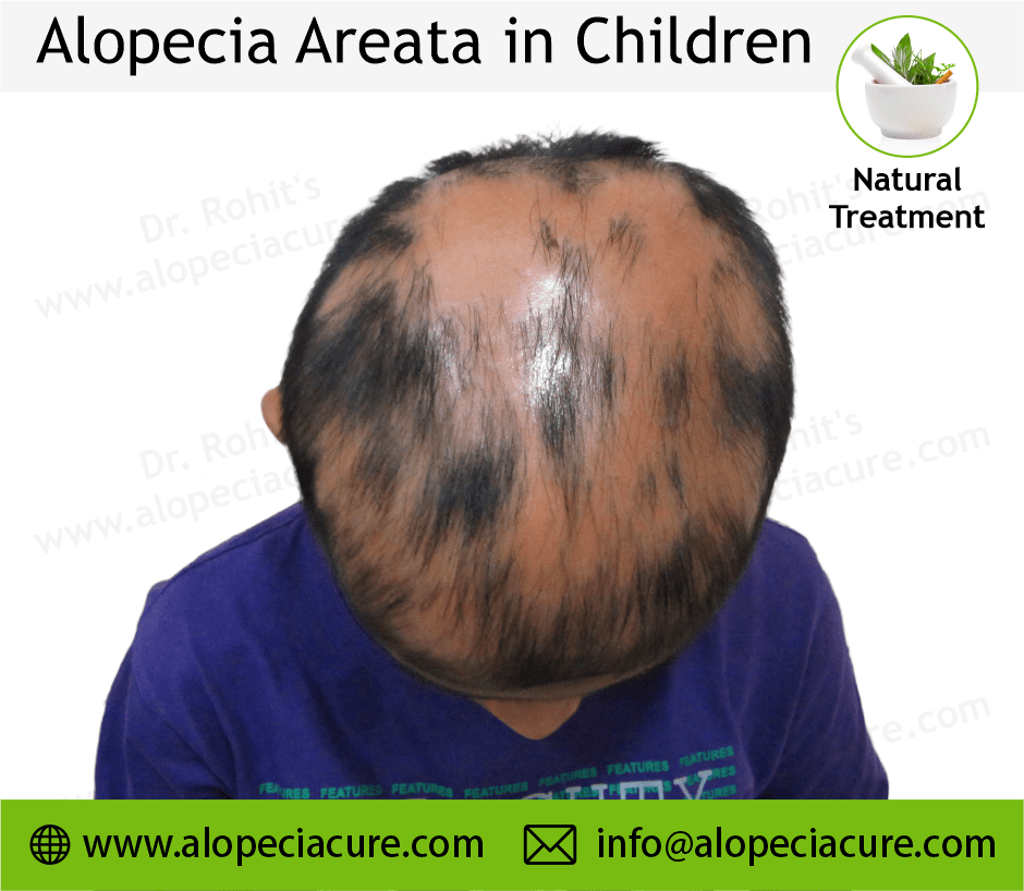 Children Alopecia Treatment Case 01