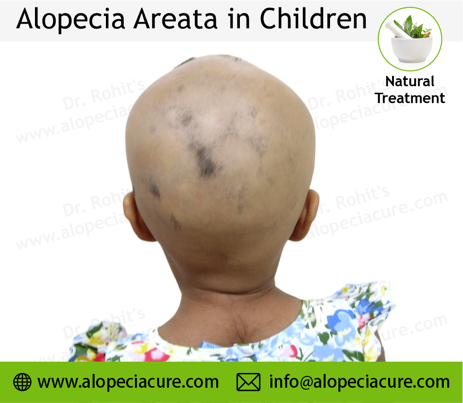 Children Alopecia Treatment Case 02
