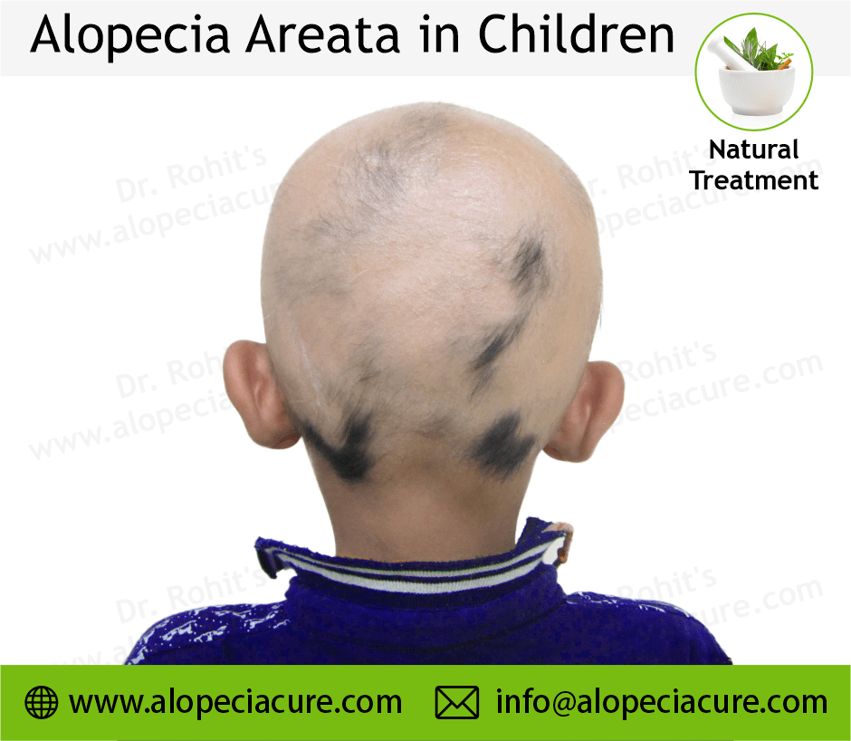 Children Alopecia Treatment Case 03