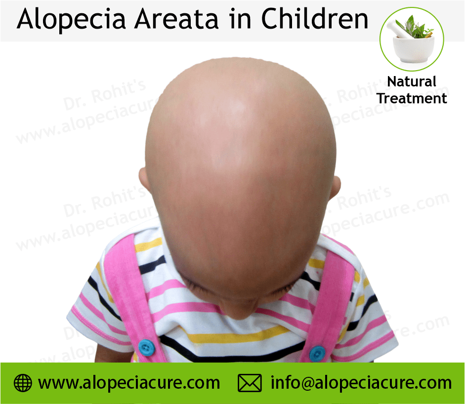 Children Alopecia Treatment Case 04