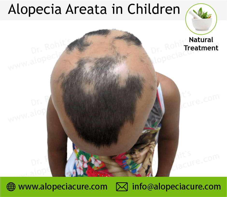 Children Alopecia Treatment Case 05