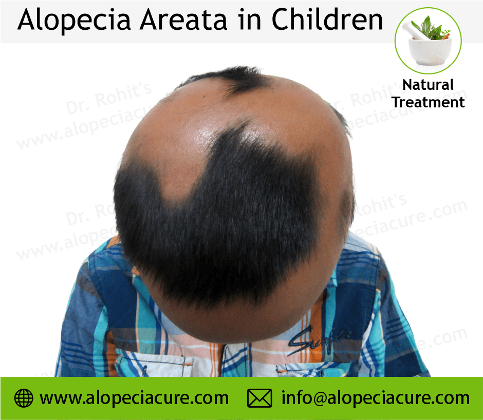 Children Alopecia Treatment Case 06