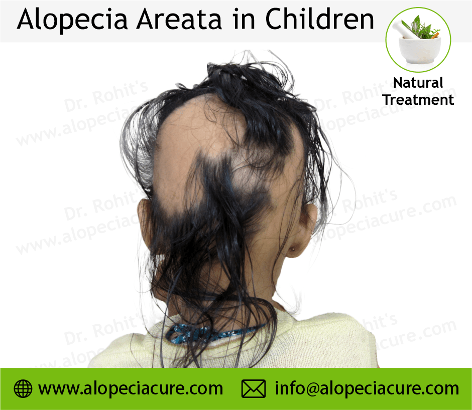 Children Alopecia Treatment Case 07